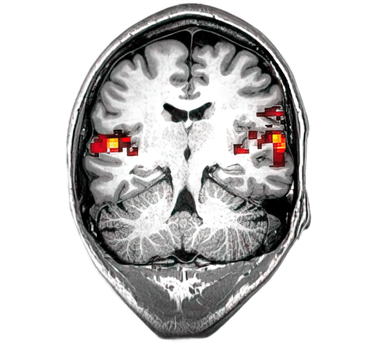 Scan of Augmented Hearing founder's brain when reacting to sound