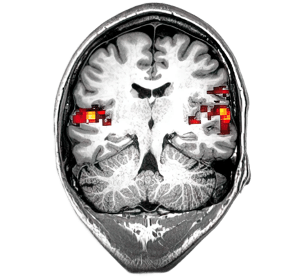 Brain Scan of Mette Carstensen reacting to sound Brain Scan of Mette Carstensen reacting to sound